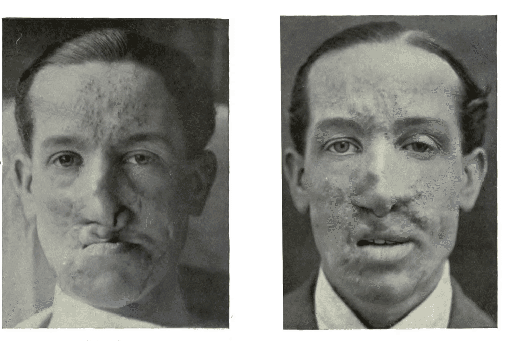 Roman soldiers receiving early plastic surgery to repair facial wounds, part of the history of plastic surgery in ancient warfare.